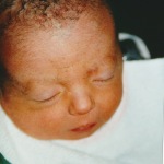 Jaël (Trisomie 18) kurz nach der Geburt, die Augen sind noch geschlossen.